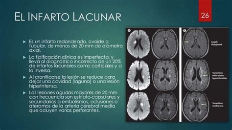 infarto lacunar cerebral